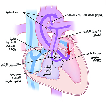 صورة أمامية من مقطع عرضي للقلب توضح رتق صمام ثلاثي الشُّرف، وقناة شريانية سالكة، وبطين أيمن صغير، وعدم وجود صمام ثلاثي الشُّرف، وثقبة بيضوية سالكة، وتضييق رئوي، وعيب بالحاجز البطيني. أسهم توضح تدفق الدم من الأذين الأيمن عبر الثقبة البيضوية السالكة وصولًا إلى الأذين الأيسر، وتدفق الدم المخلوط من البطين الأيسر إلى الرئتين ثم إلى سائر الجسم