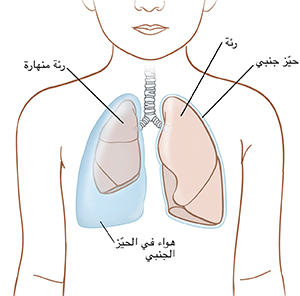 رسم تخطيطي لجسم طفل يوضح شكل الرئتين داخل الصدر. الرئة اليسرى طبيعية ومحاطة بحيز جنبي رقيق. الرئة اليمنى منهارة والحيز الجنبي مليء بالهواء.