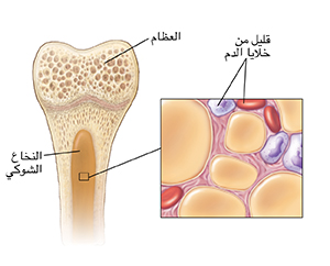 مقطع عرضي للعظام يظهر فيه النخاع وصورة مقربة لمكونات الدم في النخاع.