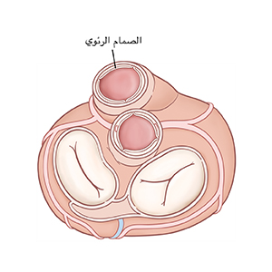 صورة علوية للقلب يظهر فيها الصمام الرئوي المفتوح.
