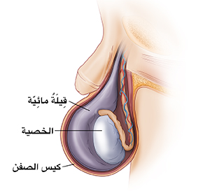 صورة جانبية لكيس الصفن تظهر أدرة متشكلة حول الخصية.