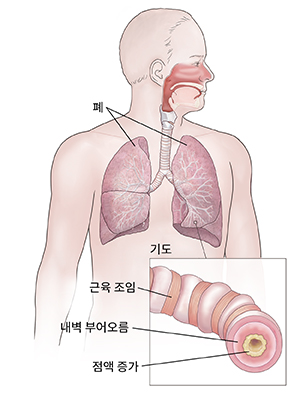 호흡계를 보여주는 남성의 전면 모습. 염증이 있는 기도를 보여주는 삽도.
