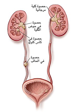 ظهور حصوات في الحالب وحصوات في الكلى في المسالك البولية.