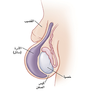 لقطة مقربة لقضيب الطفل وكيس الصفن تظهر الخصية بالداخل. يوجد كيس كبير من السائل (القيلة المائية) داخل كيس الصفن ويقوم بتكبيره.