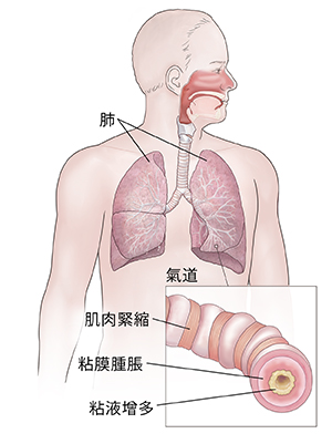 顯示呼吸系統的男性前視圖。插圖顯示發炎的氣道。