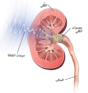 مقطع عرضي للكُلى يُظهر تكسير الموجات الصادمة لحصوة الكُلى.